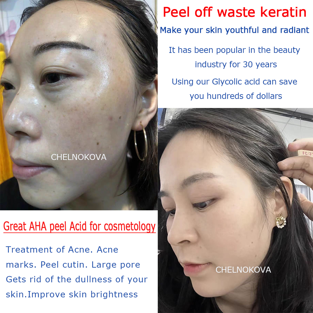 Citric acid 20% 30% 40% 50% pe - Skincare Exfoliating review and price