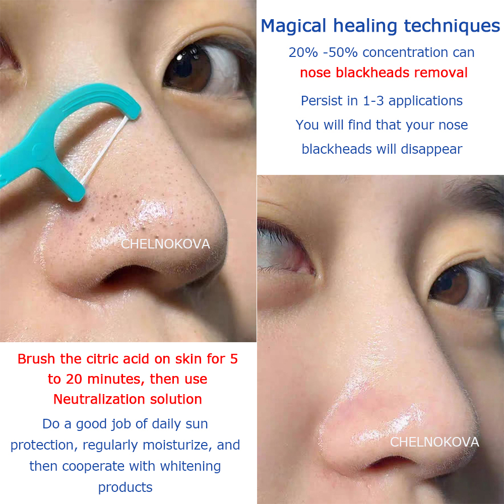 Citric acid 20% 30% 40% 50% pe - Skincare Exfoliating review and price